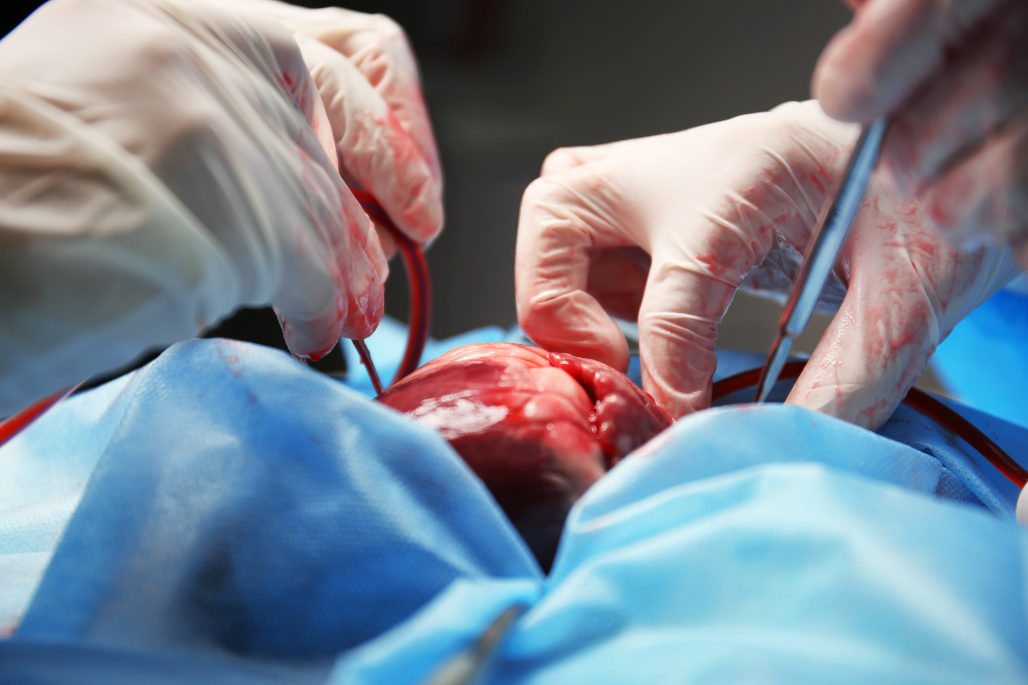 Gloved hands removing a human heart from a person's chest cavity.